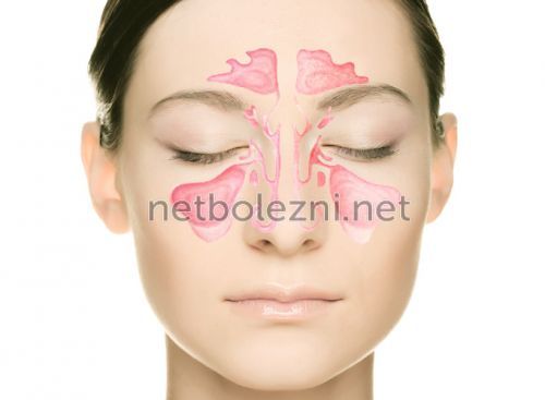 Лікування гаймориту народними засобами