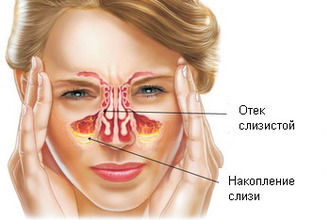 Лікування гаймориту у дорослих народні традиційні методи і профілактика Лікування гаймориту у дорослих народні традиційні методи і профілактика