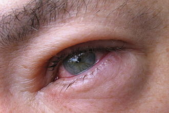 Лікування гаймориту у дорослих народні традиційні методи і профілактика Лікування гаймориту у дорослих народні традиційні методи і профілактика