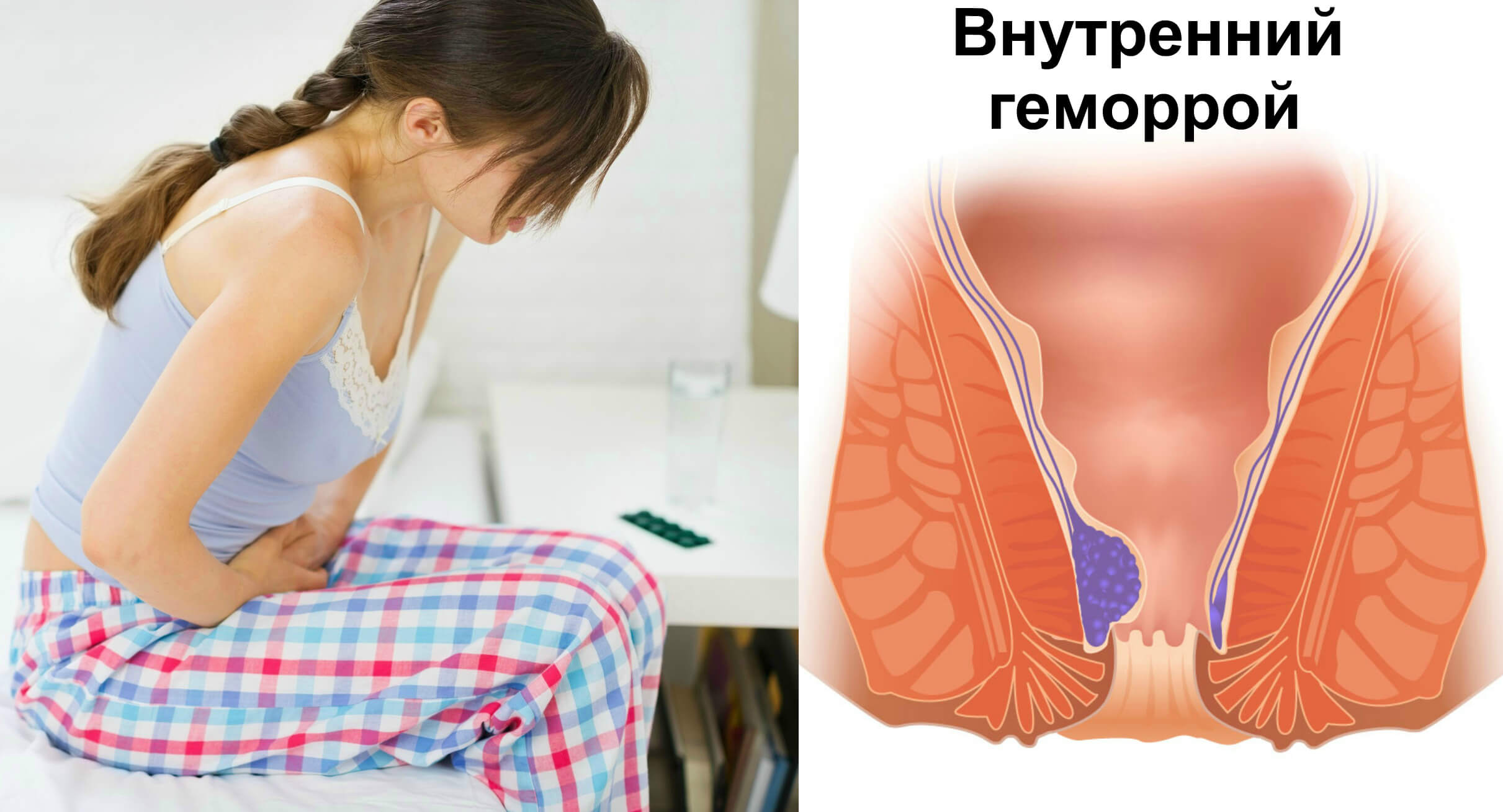 Лікування геморою в домашніх умовах швидко