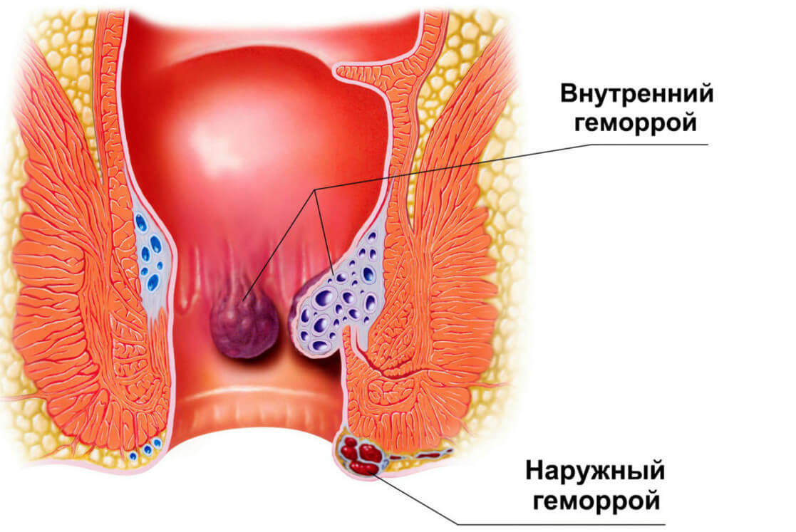 Лікування геморою в домашніх умовах швидко