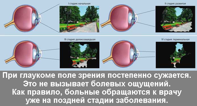 Лікування глаукоми народними засобами відгуки Народні засоби Корекція зору