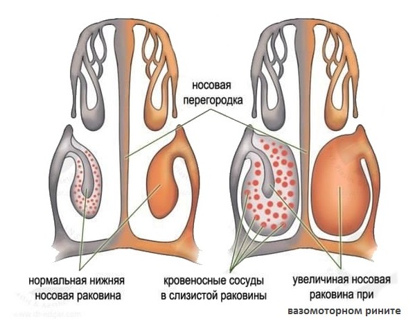 Лікування гнійного нежиті у дітей і дорослих