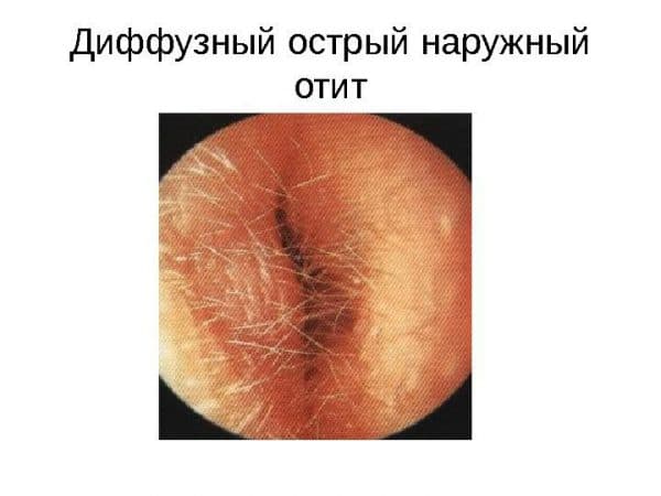 Лікування гострого зовнішнього отиту