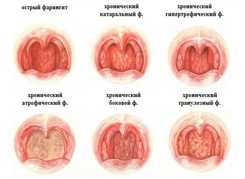 Лікування гранульозного фарингіту у дорослих і дітей