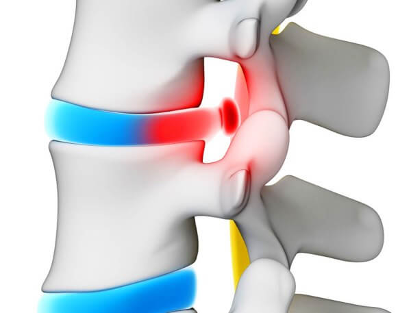 Лікування грижі хребта народними методами без операції