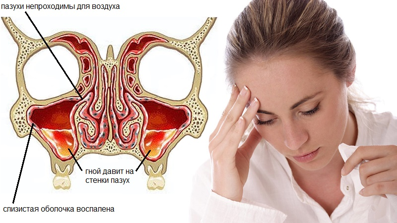 Лікування хронічного гаймориту Шлях до успіху Лікування хронічного гаймориту Шлях до успіху