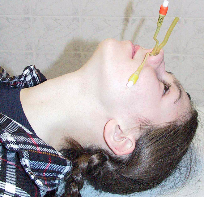 Лікування хронічного гаймориту Шлях до успіху Лікування хронічного гаймориту Шлях до успіху