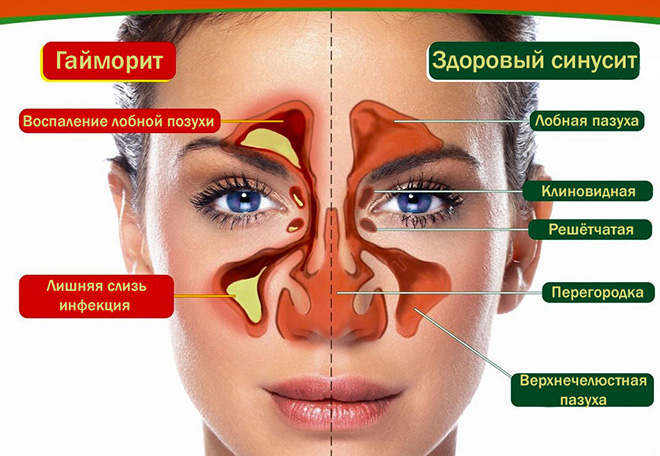 Лікування хронічного гаймориту Шлях до успіху Лікування хронічного гаймориту Шлях до успіху