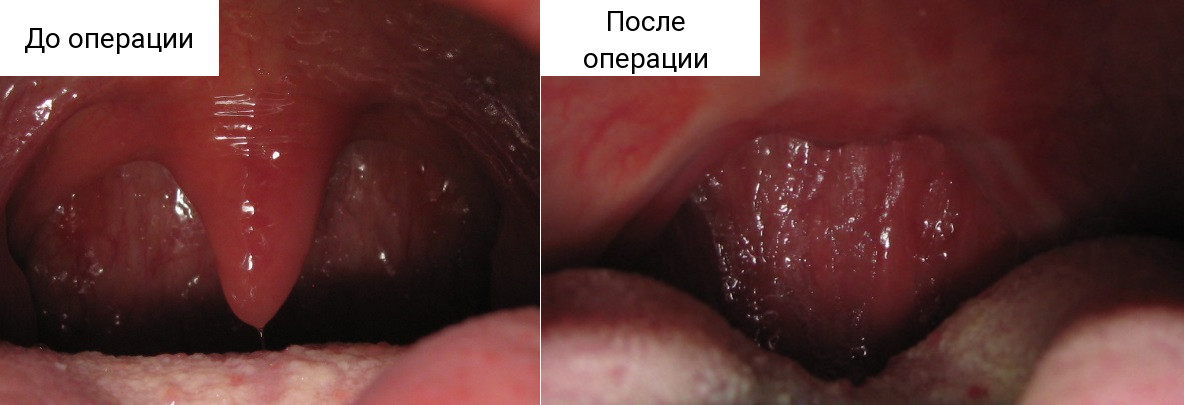 Лікування хропіння лазером – суть методу. Показання та протипоказання Лікування хропіння лазером – суть методу. Показання та протипоказання