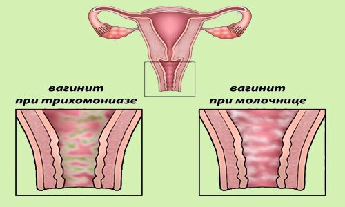 Лікування кольпіту у жінок препарати схема лікування