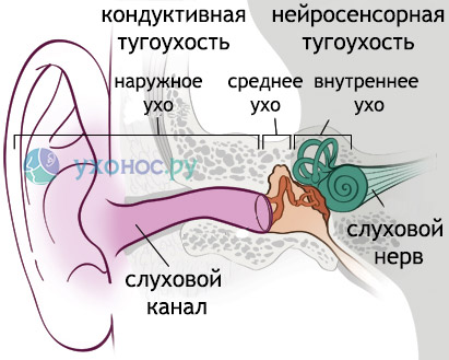 Лікування кондуктивної приглухуватості (зниження слуху кондуктивного, приглухуватості за кондуктивному типу) в Ізраїлі