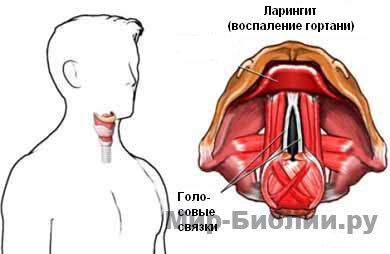 Лікування ларингіту народними засобами і методами