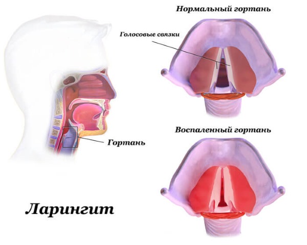 Лікування ларингіту в домашніх умовах у дорослих швидко 2019