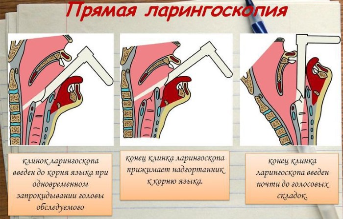 Лікування ларингіту в домашніх умовах у дорослих швидко 2019