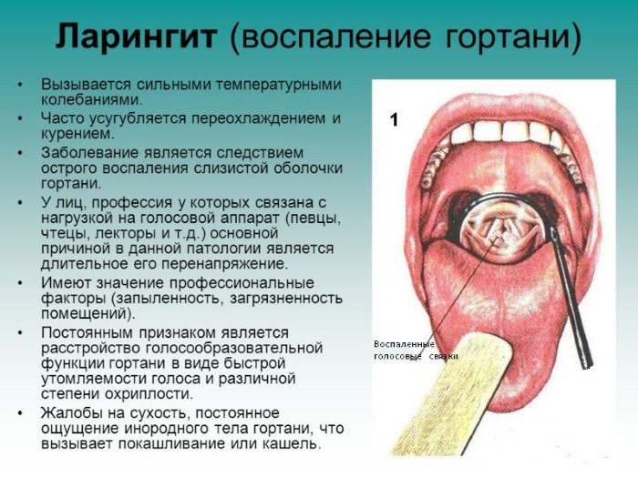 Лікування ларингіту в домашніх умовах у дорослих швидко 2019