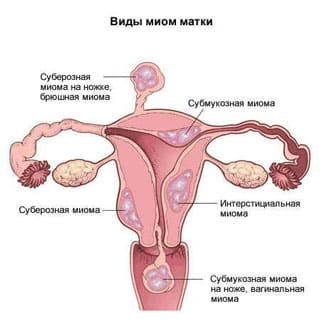 Лікування міоми матки народними засобами рецепти які допомогли