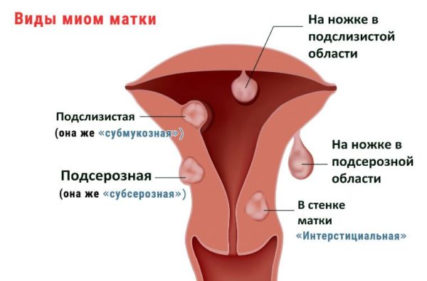 Лікування міоми матки народними засобами рецепти які допомогли