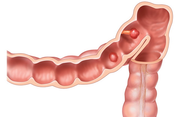 Лікування набряків народними методами: як зняти набряки народними засобами в домашніх умовах