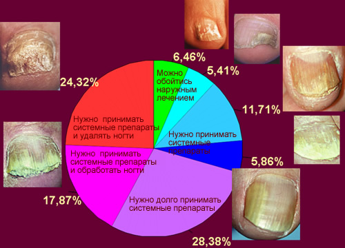 Лікування народними засобами грибка нігтів на ногах і руках