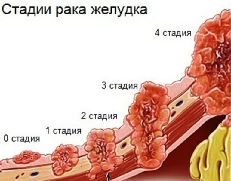 Лікування народними засобами (народне лікування) раку шлунка