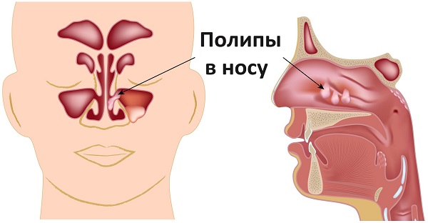 Лікування поліпів у носі без операцій