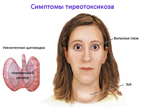 Лікування щитовидної залози у жінок народними засобами в домашніх умовах
