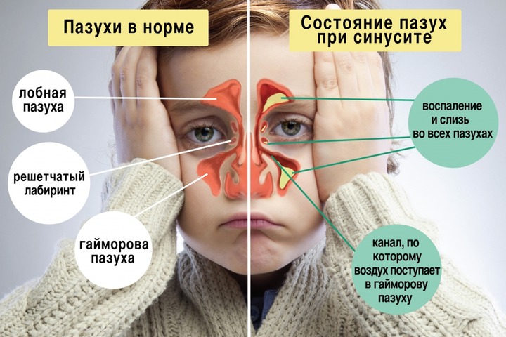 Лікування синуситу у дітей за Комаровським