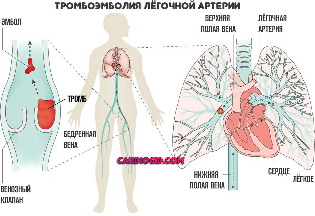 Лікування тромбоемболії легеневої артерії ТЕЛА