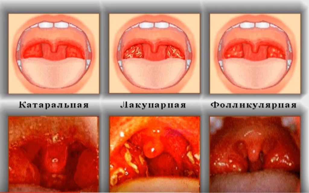 Лакунарна ангіна принципи ефективного лікування у дорослих