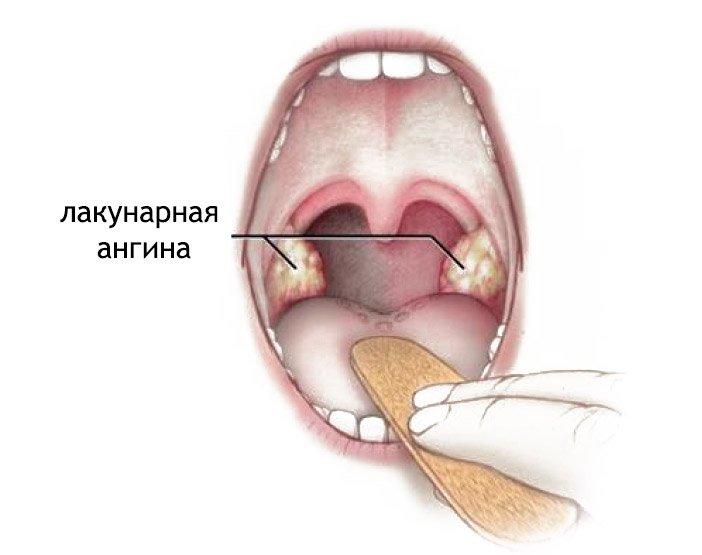 Лакунарна ангіна принципи ефективного лікування у дорослих