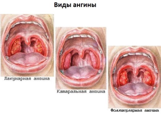 Лакунарна ангіна симптоми і лікування хвороби