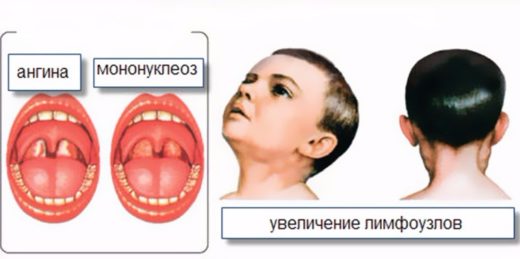 Лакунарна ангіна симптоми і лікування хвороби