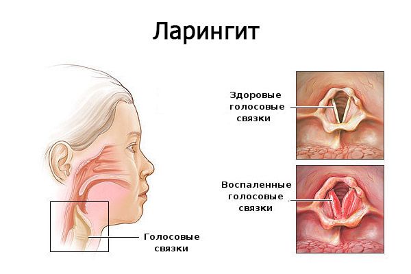 Ларингіт: антибіотики для лікування для дорослих – які препарати приймати