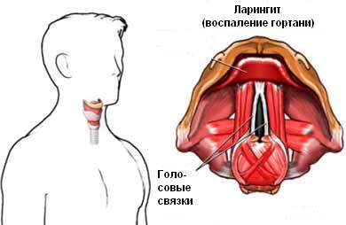 Ларингіт – симптоми і лікування у дорослих