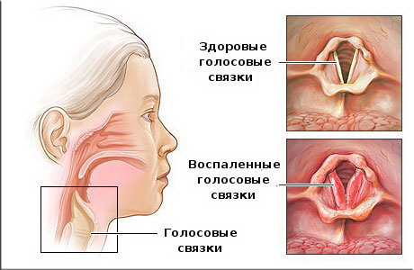 Ларингіт – симптоми і лікування у дорослих