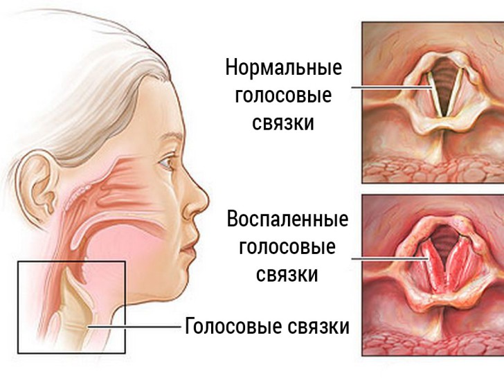 Ларингіт у дітей