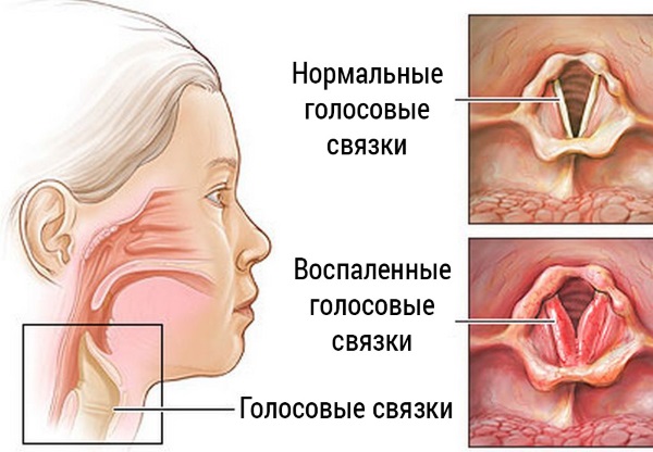 Ларингіт у дітей – симптоми, лікування, причини, гострий ларингіт у дітей