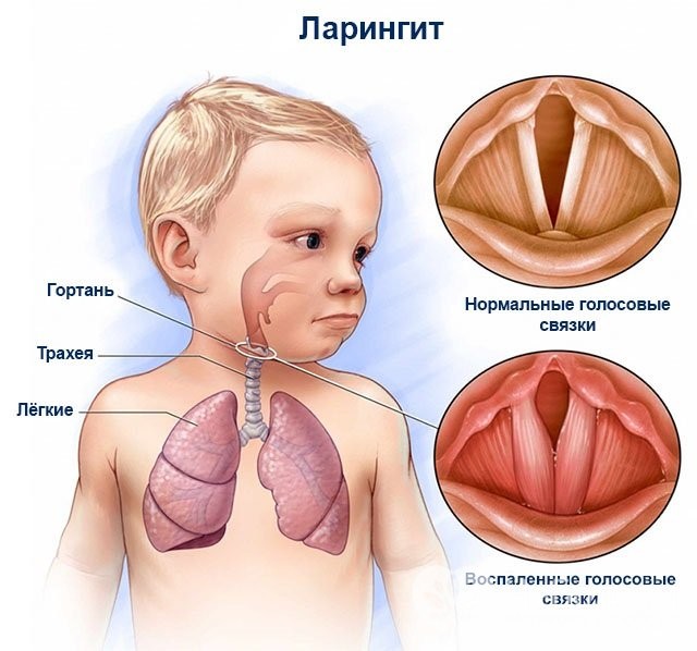 Ларингіт у дітей – симптоми, лікування, причини, гострий ларингіт у дітей