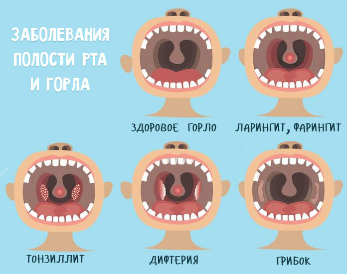 Ларингіт у дітей симптоми і лікування захворювання