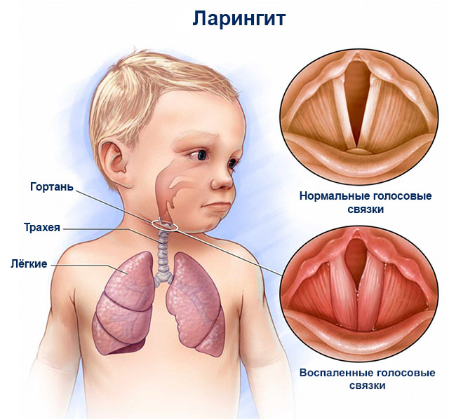 Ларингіт у дітей симптоми і лікування захворювання