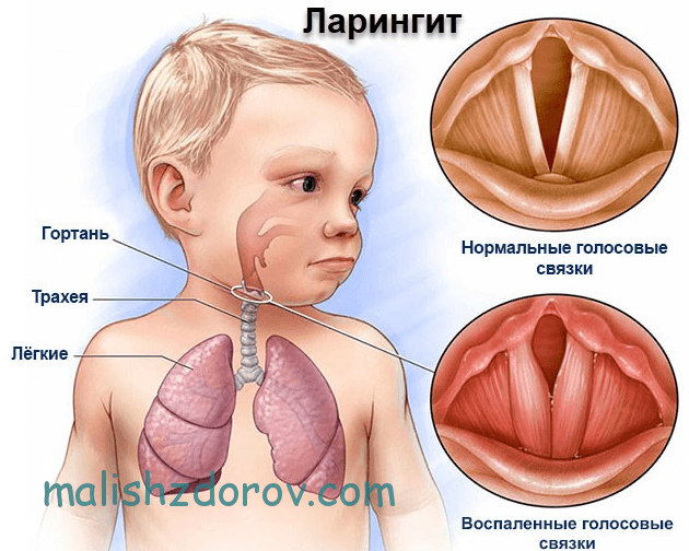 Ларингіт у дітей симптоми і лікування захворювання