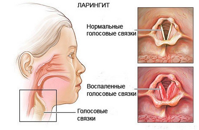 Ларингіт у немовляти – симптоми і лікування ларингіту у немовляти