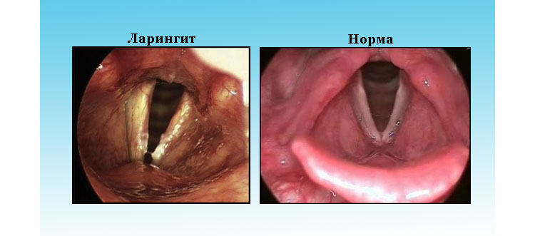 Ларингіт у немовляти – симптоми і лікування ларингіту у немовляти