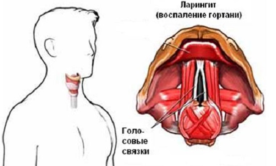 Ларингіт у вагітних особливості лікування