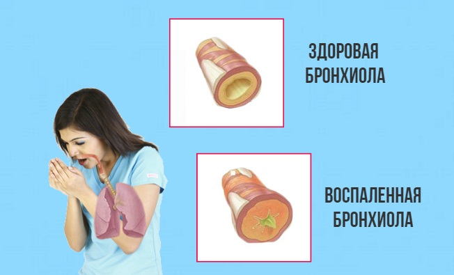 Ларингіт втрата голосу лікування у дорослих. Поради по лікуванню втрати голосу через ларингіту