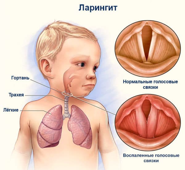 Ларингіт заразний чи ні і як його лікувати
