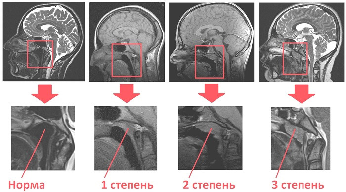 Лазерна редукція аденоїдів як проходить операція