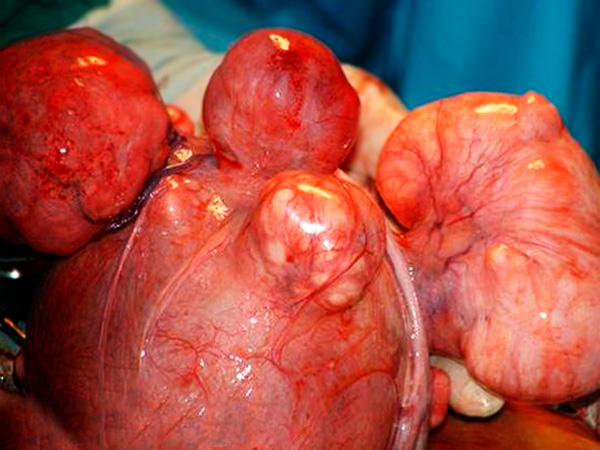 Міома матки: лікування народними засобами » Лікування народними засобами