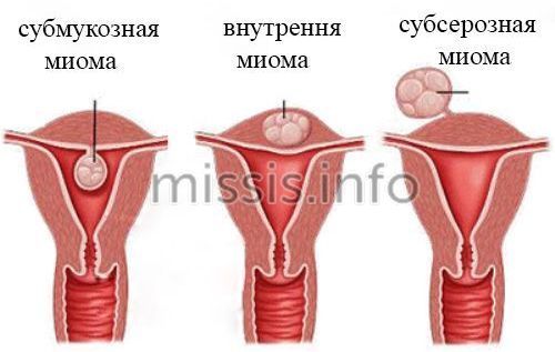 Міома матки: лікування народними засобами » Лікування народними засобами Міома матки: лікування народними засобами » Лікування народними засобами
